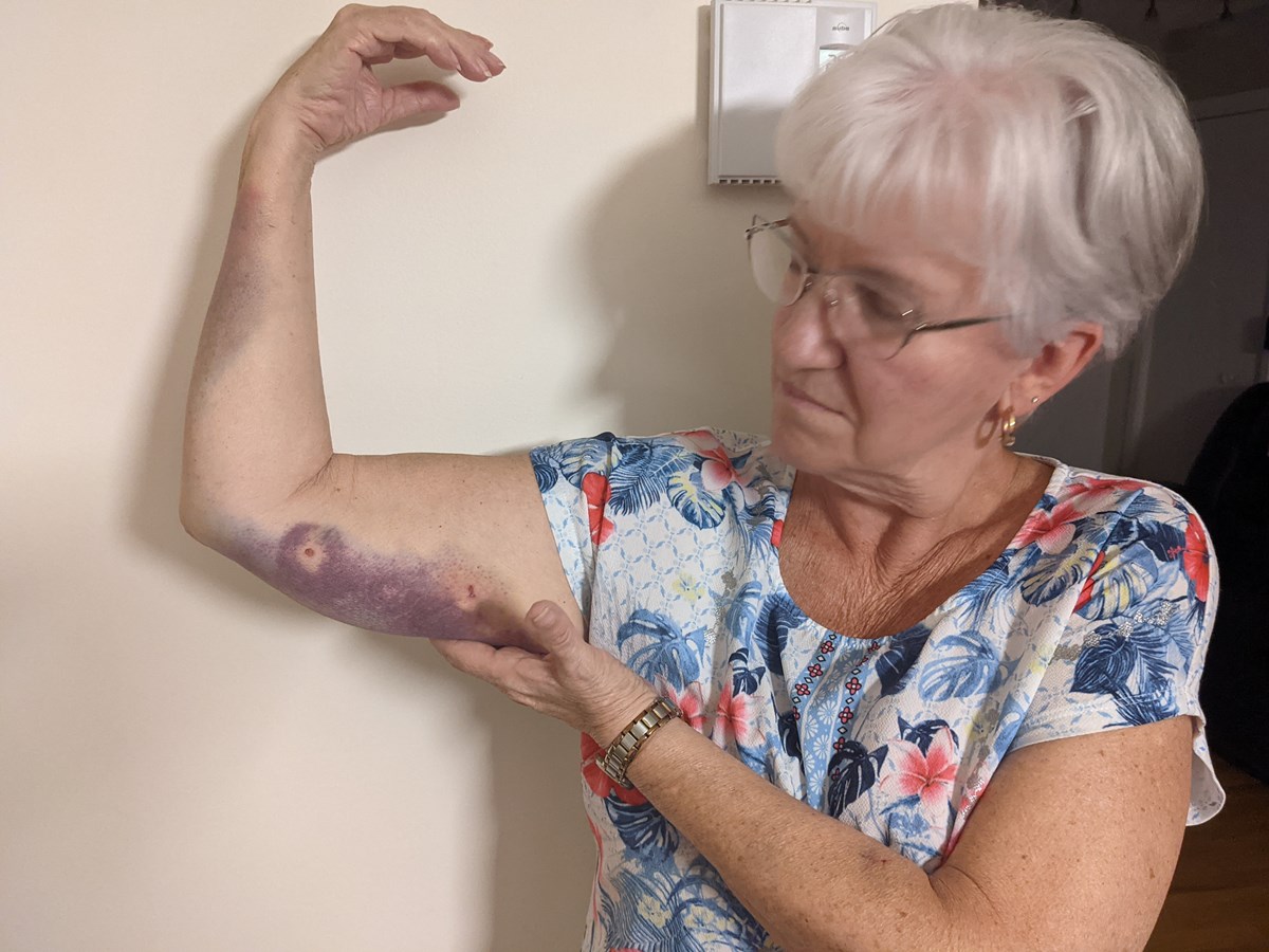 Mme Jacqueline Sévigny qui nous montre une de ses blessures subie lors de l’attaque de chiens du 31 août.